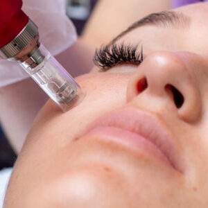 Microneedling